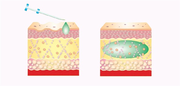 西宏醫(yī)藥“童顏針”獲批，醫(yī)療器械類服務(wù)開啟新篇章！